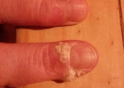 Nagelaufnahme vor der Behandlung, sichtbare Veränderungen vor dem energetischen Impuls