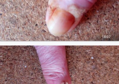 Verlauf während des Besprechens mit Veränderung der Nagelstruktur