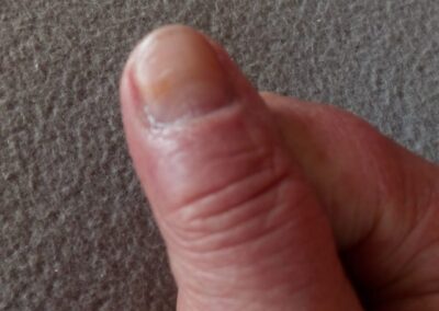 Nagelaufnahme nach der energetischen Begleitung, deutlich veränderte Struktur
